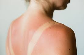 Image result for sweat rash on back