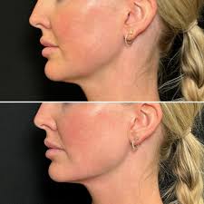 I'm no longer a worm!!! 🪱 @andrea.frederick.np worked her magic today