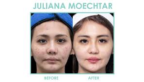A key unexplored variable in the treatment of retarded 45. Perawatan Untuk Menghilangkan Jerawat Dermaster