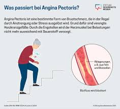 Image result for Angina Pectoris