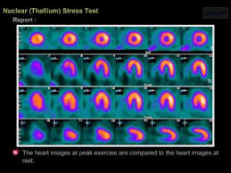 Visit & lookup immediate results now. Nuclear Stress Test Youtube