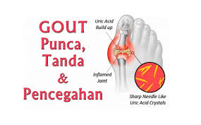 Mengambil makanan yang tinggi purine seperti organ dalaman dan makanan laut. Gout Punca Rawatan Dan Cara Untuk Mengelakkannya