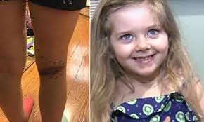 A black widow spider bite may appear as double fang marks at the site of the bite. Black Widow Spider Bite Hospitalizes A Five Year Old Girl Daily Mail Online