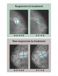 The treatment options for breast cancer are based on the type and stage of breast cancer and other factors like overall health, age, and sensitivity to certain medications. Estrogen Lowering Drugs Reduce Mastectomy Rat Eurekalert