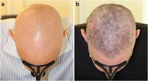 By decreasing your daily stress, you can have a direct impact on the health of your hair as well as your entire body. Alopecia Areata A Comprehensive Review Of Pathogenesis And Management Springerlink