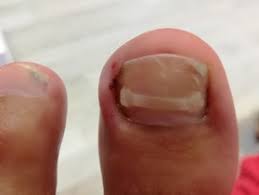 Image result for Akutní zánět nehtového lůžka