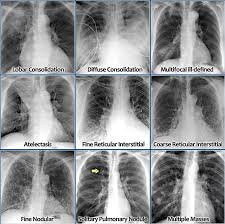 Chest X Ray Lung Disease Respiratory Therapy Radiology Medical Imaging