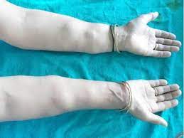 Pdf Type Iii Dercum S Disease A Case Report Semantic Scholar