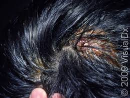 Image result for dry scabs on the head in children