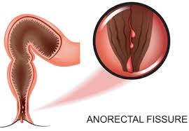Image result for Rectal prolapse