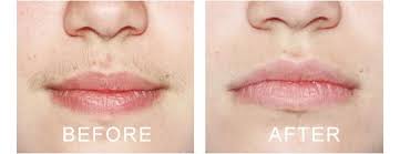 Here's a representative pricing structure based on the categories above since most aesthetic procedures need multiple treatments before seeing results, such as laser tattoo removal, many clinics tend to. Permanent Laser Hair Removal Treatment In Ludhiana Laser Treatment For Full Body In Ludhiana Laser Hair Removal In Ludhiana Full Body Permanent Laser Hair Removal In Ludhiana Laser For Bikini Hair Removal