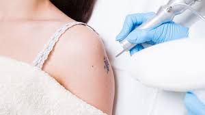 Next, the certified tattoo removal technician goes over the skin with the tattoo gun, and the removal system helps to carefully open up the surface of the skin. Laser Tattoo Removal