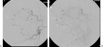 Near rhymes synonyms / related phrases mentions descriptive words definitions. Transcatheter Embolization In The Management Of Epistaxis Abstract Europe Pmc