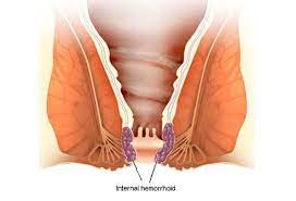 Check spelling or type a new query. How To Get Rid Of Hemorrhoids Types Causes And Treatments