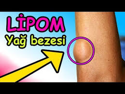 Kolda Yag Bezesi Lipom Ertan Beyatli Youtube