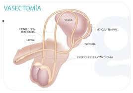 La vasectomía es uno de los métodos de control de la natalidad más efectivos. Vasectomia Grafico 1 Gifyu