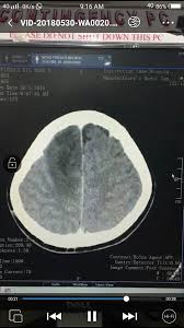 We did not find results for: Masa Kena Tu Memang Dah Rasa Macam Nak Ajal Kerap Sakit Kepala Selepas Merokok Dah Disahkan Ada Ketumbuhan Pada Otak