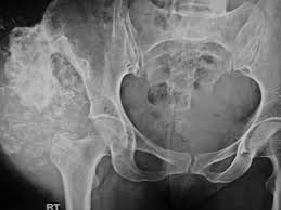 Image result for Chondrosarcoma