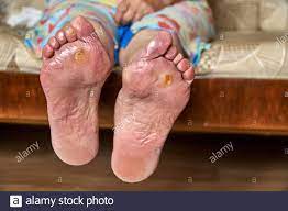 Dry Cracked Skin Woman Feet High Resolution Stock Photography And Images Alamy