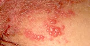 Se suele transmitir de la boca a los genitales durante el sexo oral y causar el herpes genital. Las Espinillas Dolorosas Granos Bultos Y Lesiones En Areas De Genitales Femeninas El Blog De La Salud Tu Blog De Salud Bienestar Y Nutricion