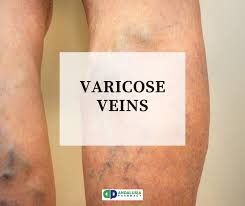 Bolehkah varicose veins membuat komplikasi untuk wanita hamil? Perasan Tak Dekat Kaki Mak Atau Ayah Andalusia Pharmacy Facebook