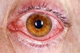 Other symptoms associated with other types of conjunctivitis, such as mucous. Conjunctivitis Nhs