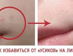 как убрать усики в домашних условиях раз и навсегда Prirodnyj Recept Udaleniya Usikov Na Lice Kosmetologiya Krasa Video Vpravi