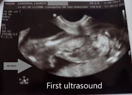 While club foot is clear to see when the baby is born, it may be diagnosed before birth if seen on an ultrasound scan. My Journey With Baby S Positional Clubfoot Part 1 Baby Gizmo