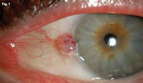Image result for lesion sclera