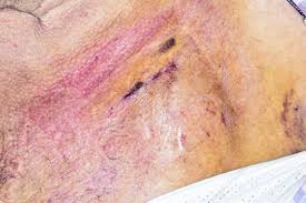 Learn about pacemakers for seniors including pacemaker care, surgery information and the differences between a pacemaker and icds. Icd Pacemaker Implant Scar Stock Image C026 9257 Science Photo Library