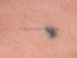 Image result for Blue Nevus