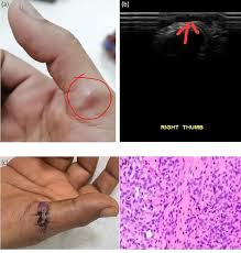 Image result for Glomus tumor