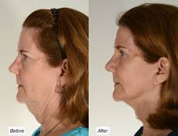 Check spelling or type a new query. How To Get Rid Of Your Turkey Neck Charleston Facial Plastic Surgery