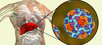 Learn about the different types here. Hepatitis Causes Symptoms And Treatment Gidoc