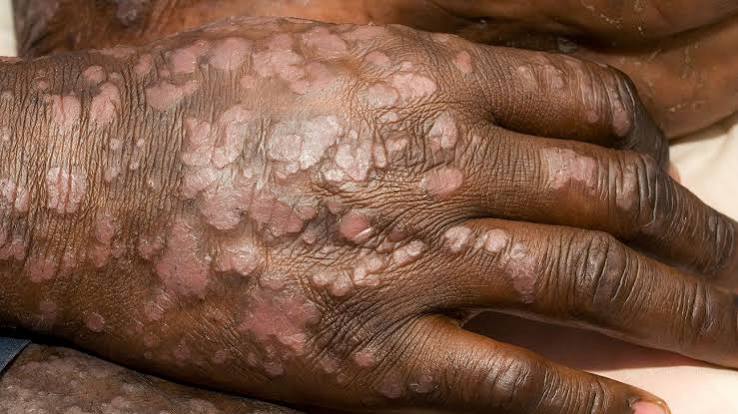 Psoriasis patch detail