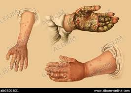 Image result for scabies norvegica
