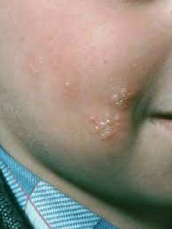 Herpes simplex virus (hsv) is highly contagious and is easily transmitted through direct contact with the lesions of an infected person. Herpes Simplex Dermatologist In Belleville Nj