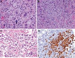 Three types of mesothelioma cells. The 2015 World Health Organization Classification Of Tumors Of The Pleura Advances Since The 2004 Classification Journal Of Thoracic Oncology
