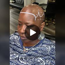 Transforming Alopecia with Scalp Micropigmentation