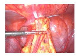 Removal, checking, reinsertion of nexplanon) * updated 10/2016. Laparoscopic Removal Of A Migrated Intra Uterine Device Embedded In The Anterior Abdominal Wall In Yaounde Cameroon A Third World Country