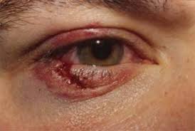 Le long de la rivière 6. Les Vaisseaux Des Paupieres Ophtalmologie