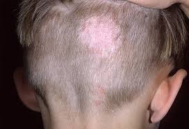 Find out what you can do to prevent and treat the infection and relieve its symptoms. Ringworm Pictures What A Ringworm Rash Looks Like
