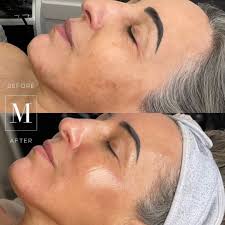 The (/ ð ə, ð iː / ()) is a grammatical article in english, denoting persons or things already mentioned, under discussion, implied or otherwise presumed familiar to listeners, readers, or speakers.it is the definite article in english. Monaco Medical Aesthetics