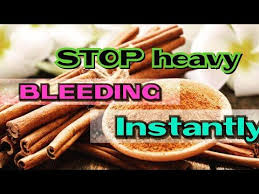 How To Stop Heavy Menstrual Bleeding Instantly Heavy Menstrual Bleeding Caused By Pcos Fibroids Heavy Menstrual Bleeding Menstrual Bleeding Heavy Bleeding
