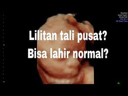 Namun dalam proses persalinan dimana mulai timbul kontraksi rahim dan kepala janin mulai turun dan memasuki rongga panggul, maka lilitan tali pusat menjadi semakin erat dan. Lilitan Tali Pusat Bisa Lahiran Normal Youtube