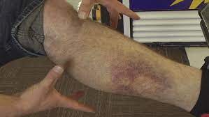 A bite from a rattlesnake can be lethal, but most snakebite victims survive their encounter. Rattlesnake Bite Victim Walks 45 Minutes For Help Keci