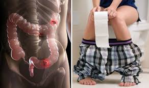Bowel cancer affects the digestive system between the stomach and the anus. Cancer Three Colours Of Faeces That Could Be A Sign Of A Growing Tumour In The Bowel Samachar Central