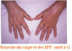 Polyarthrite rhumatode - Clinique de la main, chirurgie de la main