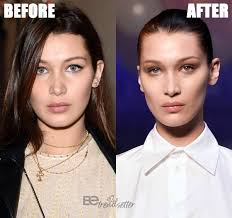 Eyelid cysts are not cancerous and. Bella Hadid Plastic Surgery Secrets Exposed