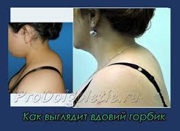 с помощью каких упражнений можно убрать живот и бока Kak Ubrat Vdovij Gorbik Medicina Zhenshina